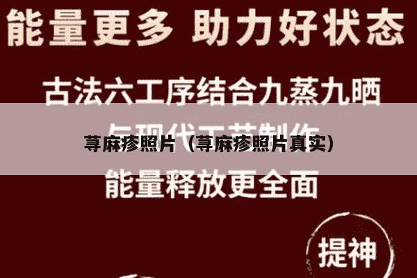 荨麻疹照片（荨麻疹照片真实）