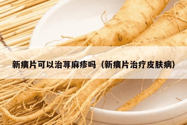 新癀片可以治荨麻疹吗（新癀片治疗皮肤病）